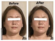 ショウフェイスデザイン(Sho Face Design)/《小顔矯正》ビフォーアフター