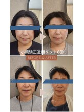 チルアウト 豊見城(Chill out)/効果大！小顔矯正造顔リフト術！