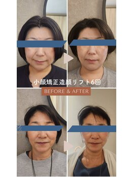 チルアウト 豊見城(Chill out)/効果大!小顔矯正造顔リフト術!