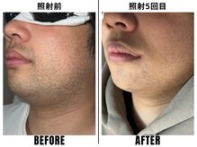 ストック 立花店(STOCK)の雰囲気（5回でほぼ完了◎青ヒゲから解放され清潔感UP）