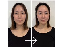 ドクターボディ 浜松店(Dr.Body)/【フェイスライン/瞼の重み】