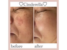 シンデレラ しみケア(Cinderella)/シミケアプログラム