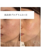 シーズ(C’s)/ＡＤＳ化粧品使用3ヵ月