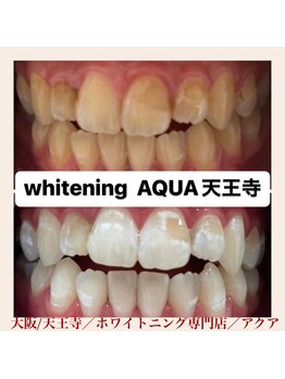 アクア 天王寺店(AQUA)/セルフホワイトニング/天王寺