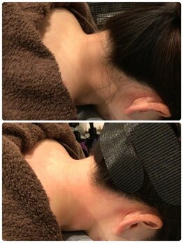 ビープラス(B plus)/効果長持ちうなじMIX脱毛☆