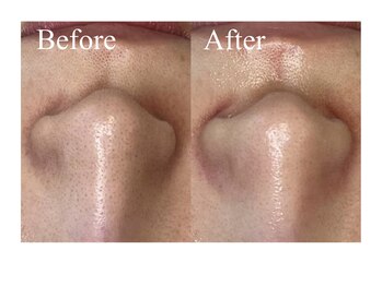 ベルティーク(BELTHEQUE)/毛穴ケア