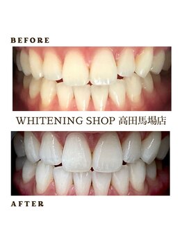 ホワイトニングショップ 高田馬場店/ホワイトニングBefore After