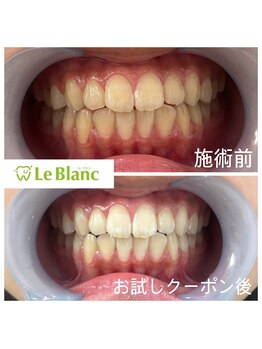 ルブラン 奈良店(Le Blanc)/学生人気もあるホワイトニング