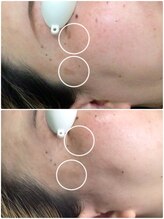 シェアキ(Chez Aki)/シミケアBefore After 