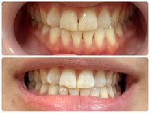 クロワ(croix)/ホワイトニング初回/透明感UP