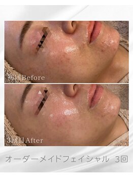 アマテラススキンラウンジ(Amatelas SKIN LOUNGE)/オーダーメイドフェイシャル