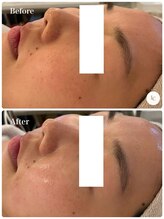 スキンセラピーサロン ル クレール(Le Clair)/Before→After