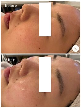 スキンセラピーサロン ル クレール(Le Clair)/Before→After