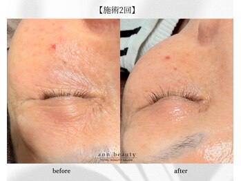 アン ビューティー(ann beauty)/施術2回/まつ毛美容液3週間使用
