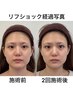 【初回】小顔×美肌 リフショック＋光 ￥18,000→￥14,000