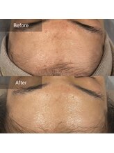 癒える(ielu)/陶肌トリートメント★BA★ハーブ