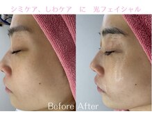 Cスキンケアクリニック 麻布店/光フェイシャルBeforeAfter