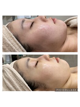 クリスタル(CRYSTAL)/光フェイシャル