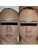 ホワイトアクア 梅田本店(WHITE AQUA)/ララピール/大阪/梅田/毛穴/小顔