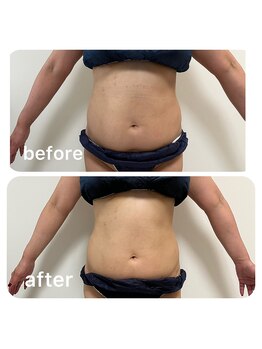 ルクール(Le Couer)/５０代痩身１回の効果