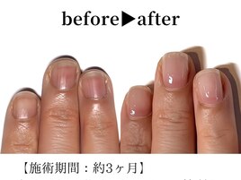 深爪・育爪専門コース