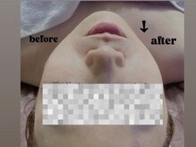 美門/フェイシャル