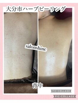 サロンシャイン(Salon Shine)/背中ハード2回