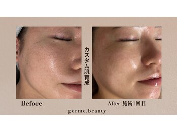 ジェルム(germe.)/大人気★お肌の凹凸ケア