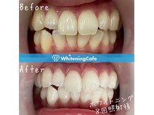 ホワイトニングカフェ 西宮北口店(Whitening Cafe)の雰囲気(ホワイトニング症例写真はフォトギャラリーをCheck★)
