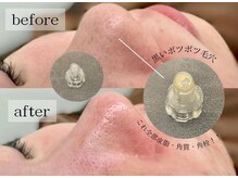 グランビューティ(Glanz Beauty)の雰囲気（最新機器で従来の毛穴洗浄よりも低刺激◎水流の力で汚れをオフ）