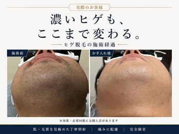 エアリアル 中津店の写真/濃いヒゲもここまで変わる。実績と丁寧さで選ぶメンズ脱毛