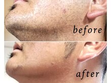 ルクール 東三条店(Le Coeur)/◇men'sヒゲ脱毛◇