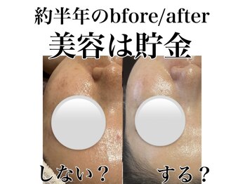 サロンツキ(salon tuki)/【ハーブピーリング】症例