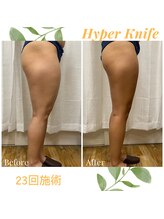 ハリルル 併設 GLケンタ鍼灸整骨院(HARILULU)/デトックス