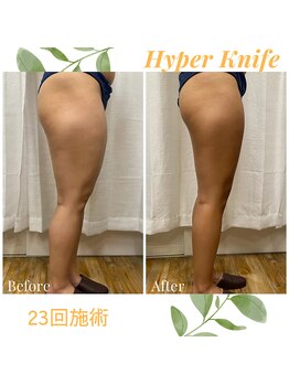 ハリルル 併設 GLケンタ鍼灸整骨院(HARILULU)/デトックス