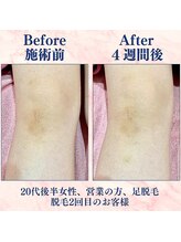 カラフル(caratful)/わき脱毛 Before After 