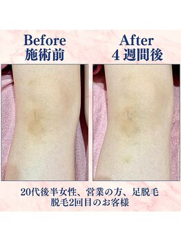 カラフル(caratful)/わき脱毛 Before After 