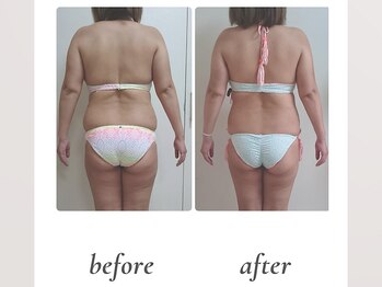 ルビーズ 柏店(RUBYZ)/ 7回施術／ボディラインの変化