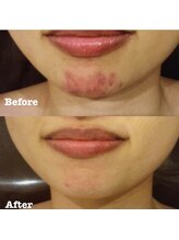 アユアランリンク 札幌店/20代前半/肌荒れ