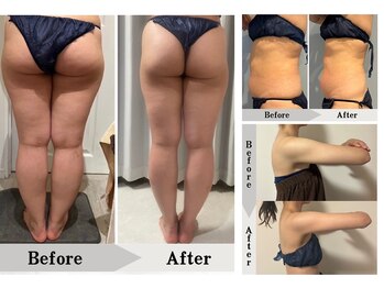 エミット(emit)/脂肪燃焼&分解