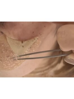 シミしわ改善！予防ケア