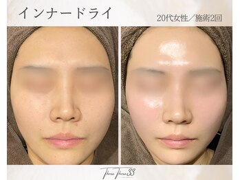 スリースリー(THREE THREE)/インナードライケア