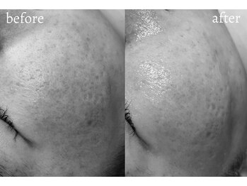 エミライ(emirai)/毛穴レスなお肌に