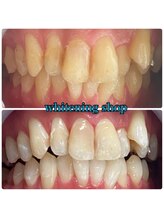 ホワイトニングショップ 池田店/【BEFORE/AFTER】