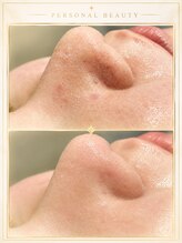 PB/ハイドラ(毛穴洗浄)