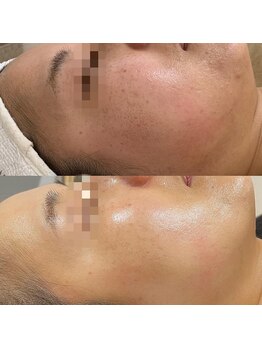 ラ クレール ビューティーサロン(LA CLAIR)/症例(エイジングケア)