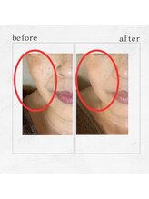 サロンドビューティー 美ふぅ(salon de beauty 美ふぅ)/しみ改善6回の結果