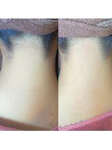 ヴァージンワックス 恵比寿店(Virgin Wax)/【うなじ】ビフォーアフター