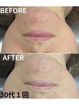 リノア 堀江(Linoa)/毛穴洗浄＆ハーブピーリング