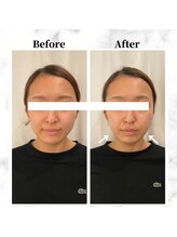 ザビューティー 麻布十番本店(The Beauty)/12Dリフト全顔打ち放題[リフト]